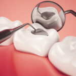 toxic mercury amalgam fillings