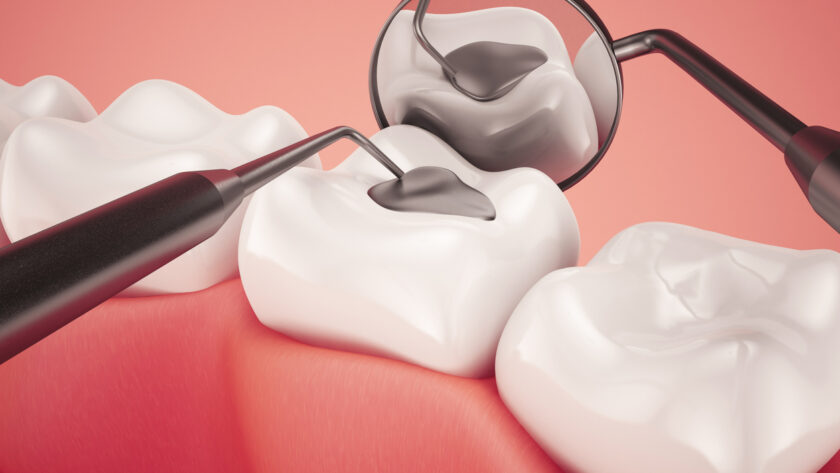 toxic mercury amalgam fillings