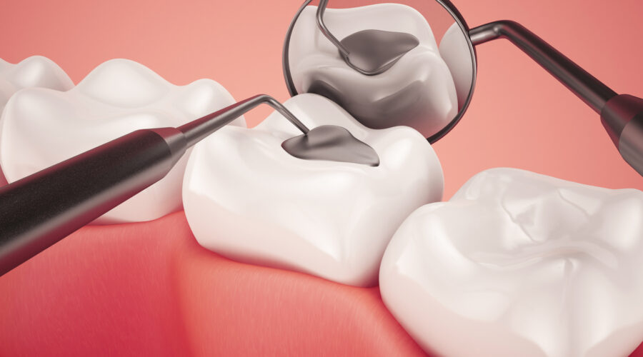 toxic mercury amalgam fillings