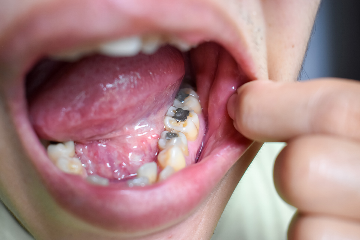 amalgam fillings