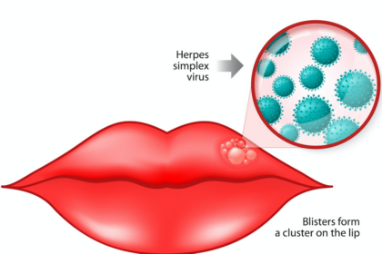 cold sores