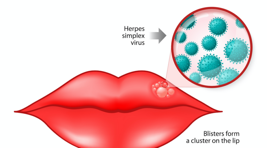 cold sores