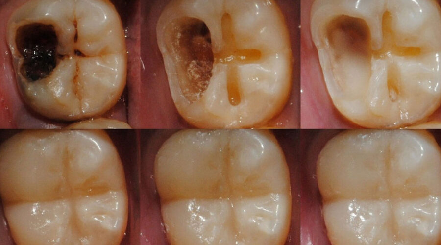tooth regeneration