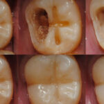 tooth regeneration