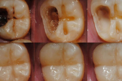 tooth regeneration