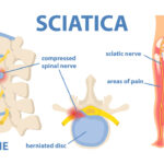 sciatic nerve