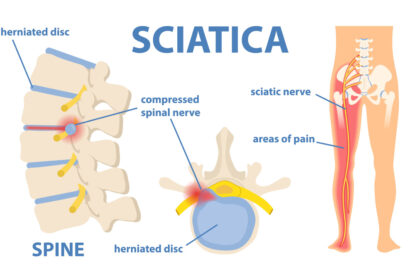sciatic nerve