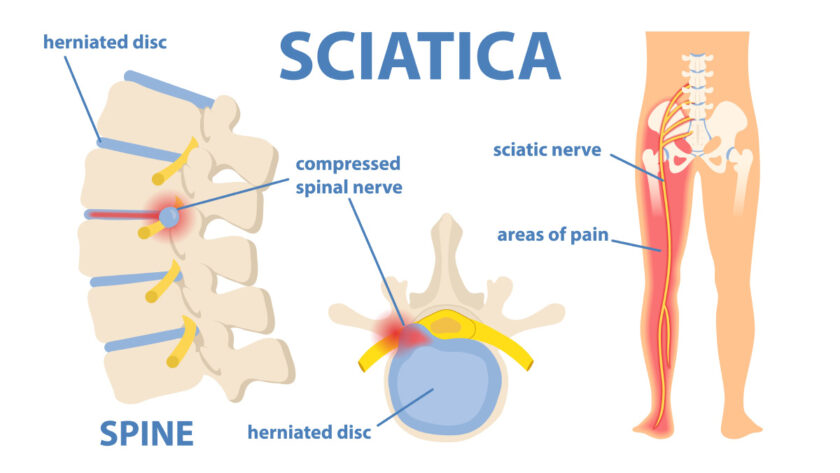 sciatic nerve