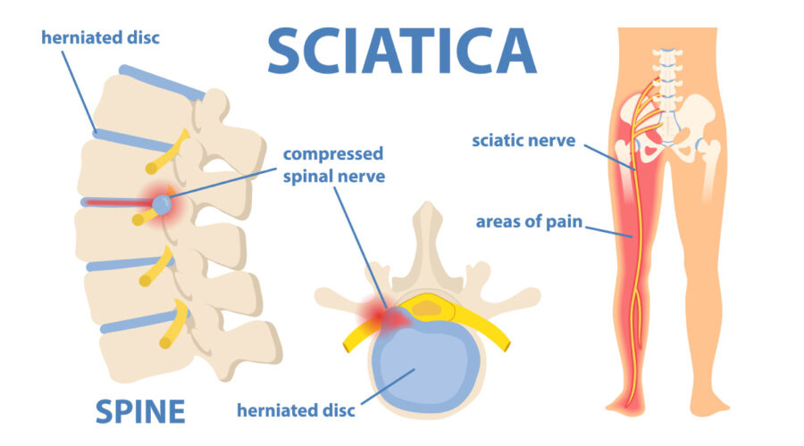 sciatic nerve