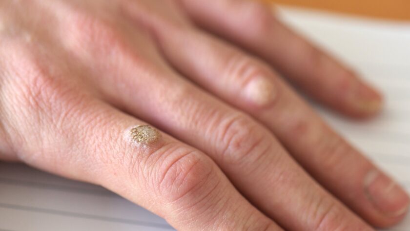 wart