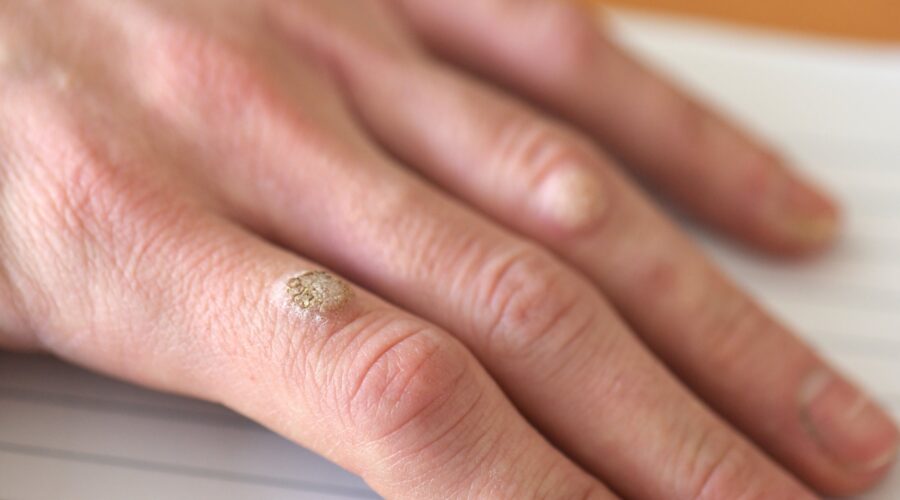 wart