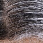 premature graying