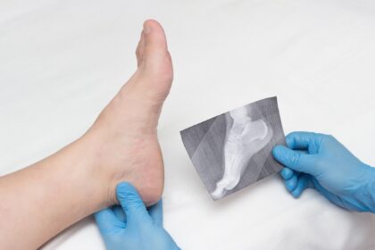 bone spurs