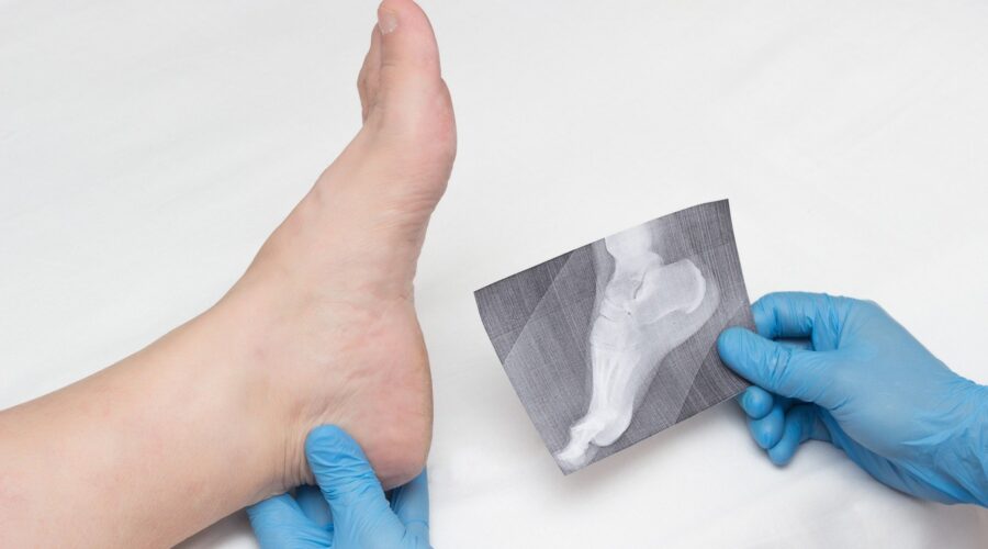 bone spurs
