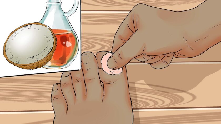 ingrown toenails