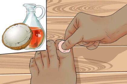ingrown toenails