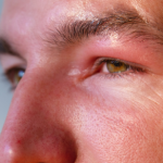 dry puffy eyes in the morning
