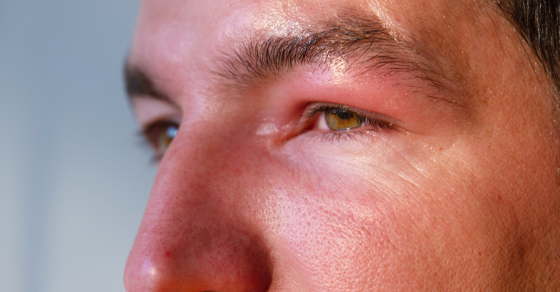 dry puffy eyes in the morning